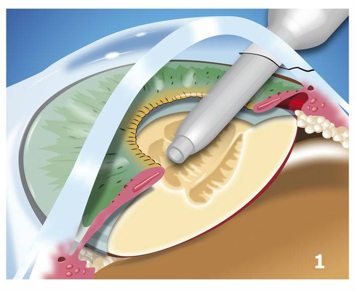 phacoemulsification