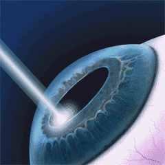 laser excimer sur cornee