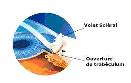 operation chirurgicale glaucom
