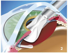 CVB insertion implant