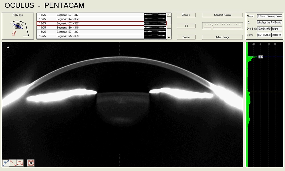 CVB pentacam